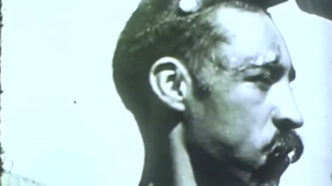 Rabies in a Human Patient